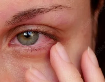 Illustration showing the anatomy of dry eye syndrome